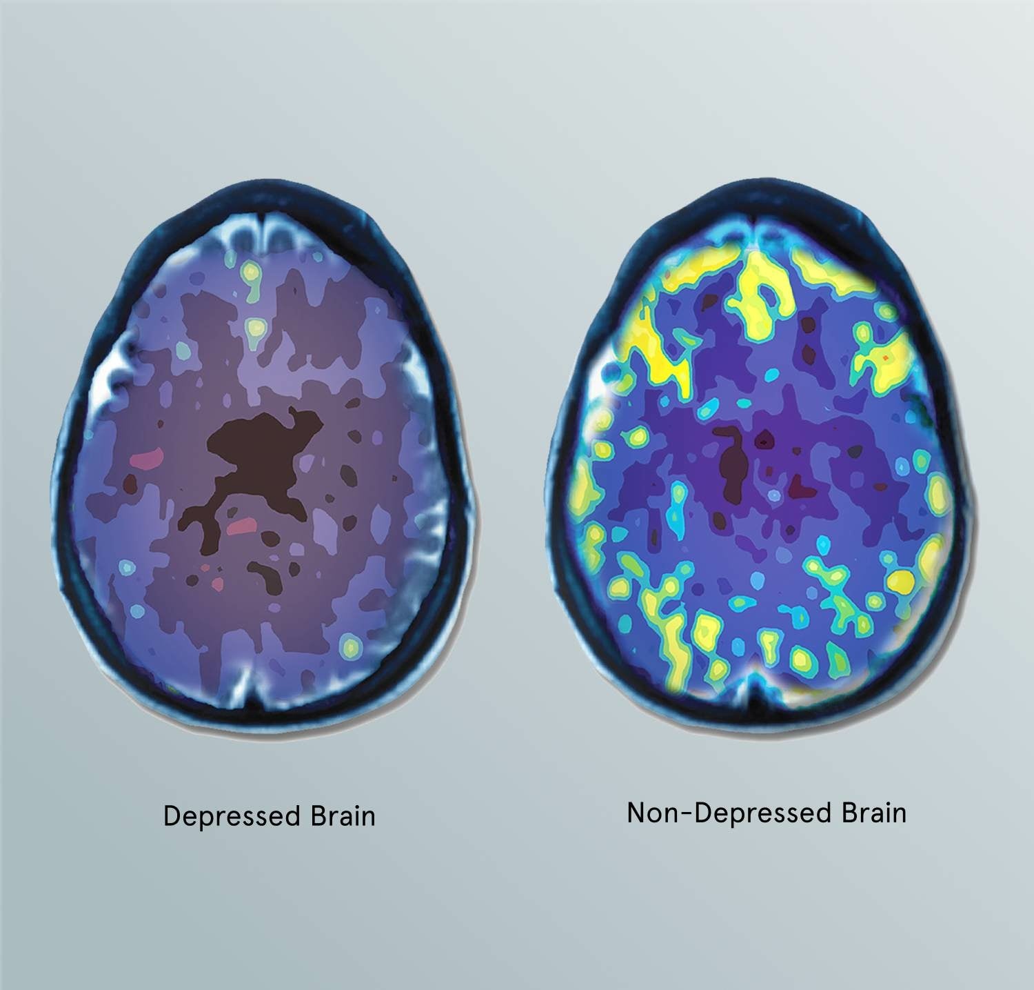 Deep TMS for treatment resistant depression